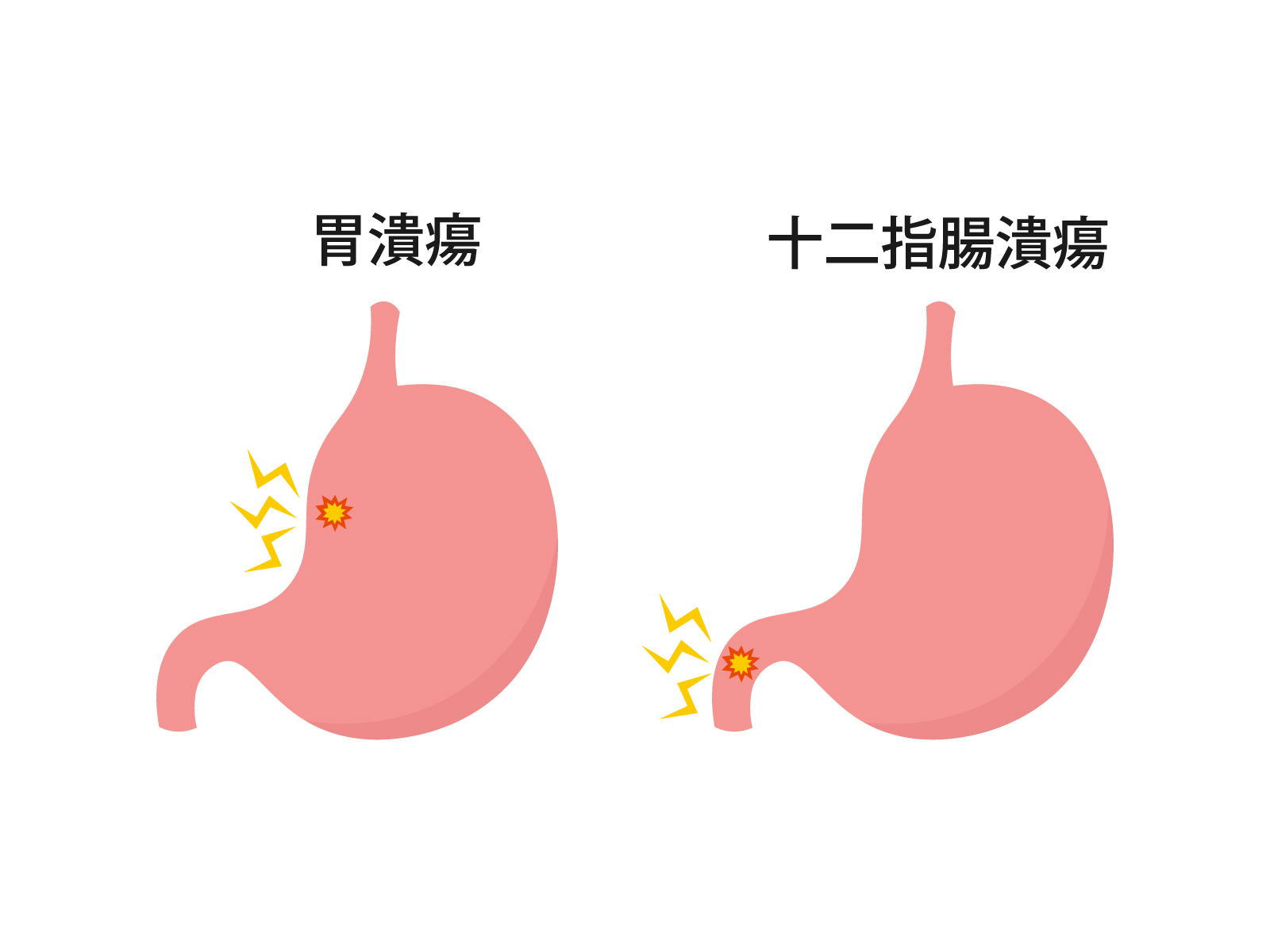 胃潰瘍・十二指腸潰瘍
